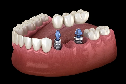 Implant-Supported Bridge