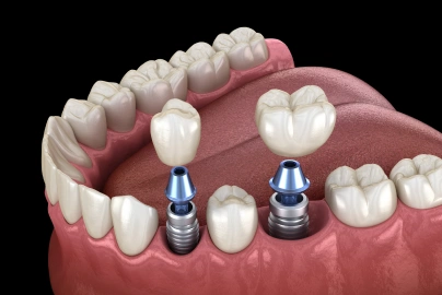 Multiple Tooth Implants